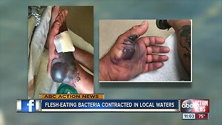 Flesh-eating bacteria contracted in Tampa Bay area waters