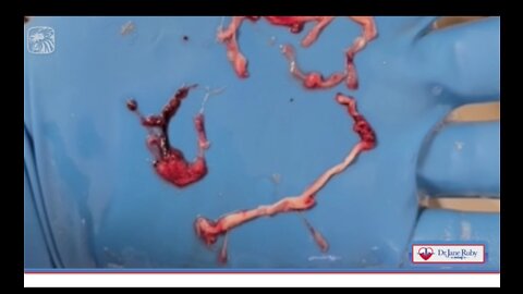 "TURNS THE BLOOD TO GLUE" Embalmers INCREASINGLY Finding Veins & Arteries Filled with huge Rubbery Clots
