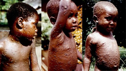 Here is what you need to know about Monkeypox