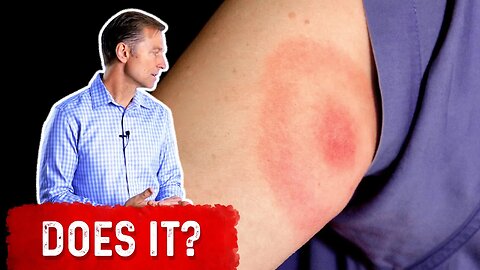 Does the Bullseye Rash Mean Lyme Disease?