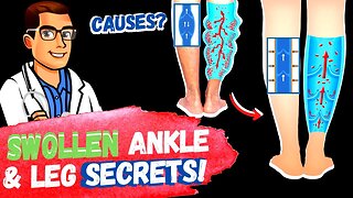 Lymphedema Treatment [How to Get Rid of Swollen Feet, Ankles & Legs]