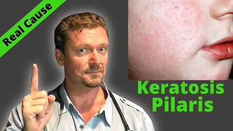 Causes of Keratosis Pilaris? (Serious Condition Sign?) Chicken Skin Fix