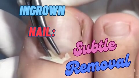 Ingrown Nail: Subtle Removal 😊😊