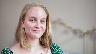 My Acne's So Bad My Dermatologist Grimaced | SHAKE MY BEAUTY