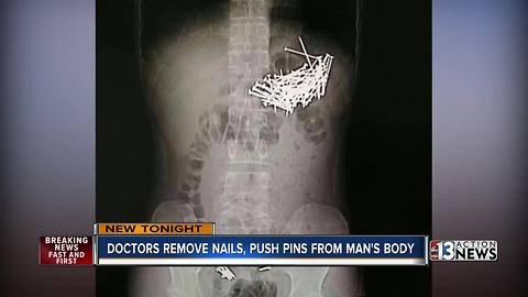 87 nails removed from man's body