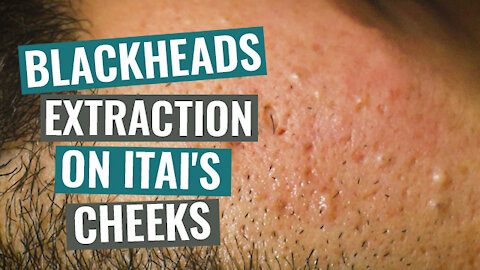 Blackheads extraction on Itai's cheeks