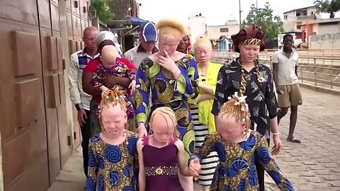 Africa's rising heat threatens those with albinism | REUTERS | NE