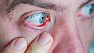 OLHOS SECOS? AQUI ESTÁ O QUE ELES REVELAM SOBRE SUA SAÚDE