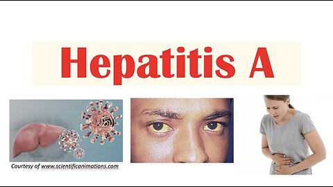 Hepatitis A | Virus, Risk Factors, Pathophysiology, Signs & Symptoms, Diagnosis, Treatment