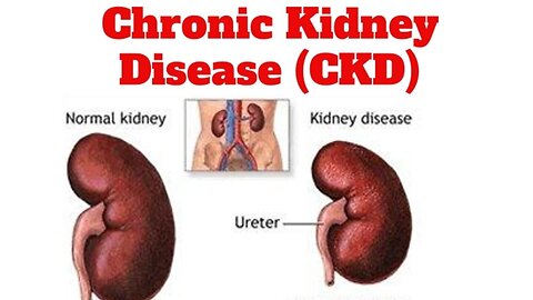 Guidelines For Chronic Kidney Disease
