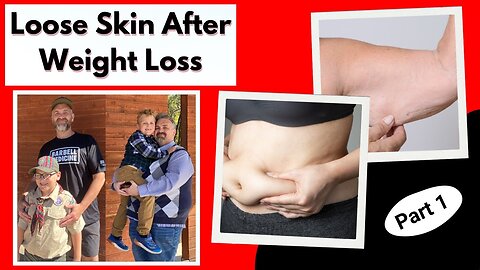 Loose Skin After Weight Loss: Causes And Prevention Strategies