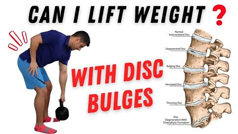 Can you lift weight in the gym with disc bulges?