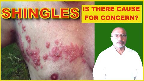 Shingles (Symptoms, Treatment, Complications)