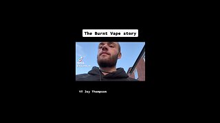 The burnt vape story