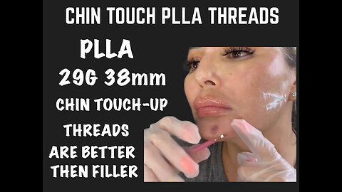 Chin Enhancement using PLLA