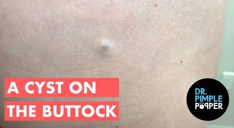 A Cheeky little Cyst... Dr Pimple Popper