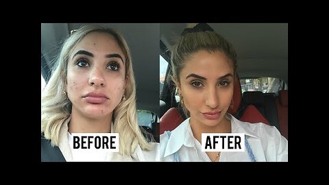 Skincare Routine: How I Got Rid Of Acne In 1 Week