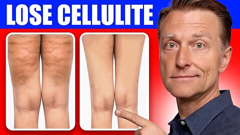 Get Rid of Cellulite for Good: Dr. Berg's Better Way to Lose Flabby Fat