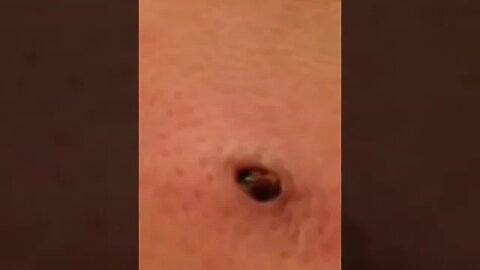Much better than excepted - Huge Ingrown Blackhead