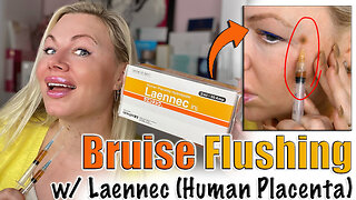 Bruise Flushing with Laennec (Human Placenta) AceCosm | Code Jessica10 saves You Money!