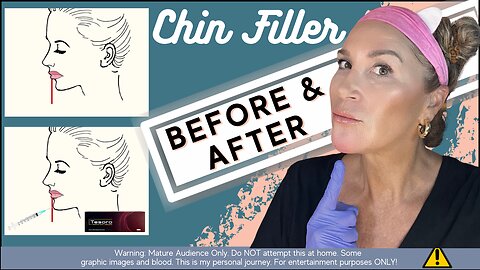 I Want to Share With YOU What To Expect Before & After Chin Filler!