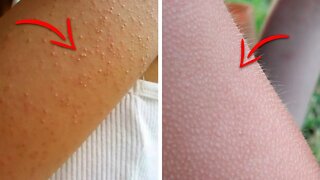 Do You Have Those Tiny Bumps on Your Arms? Here's What They Mean