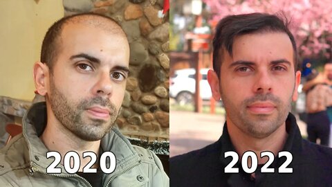 Calvo até Novembro de 2020, transplante capilar antes e depois