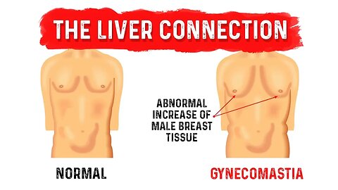 What is Gynecomastia (Man Boobs)? - Dr.Berg on Liver