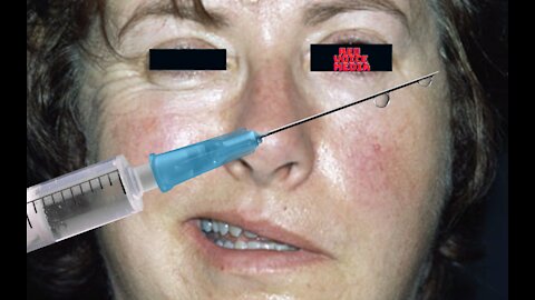 SHOCKING: 2,500+ VAERS Reports Of Bell's Palsy/Facial Paralysis After Controversial "Vaccines"
