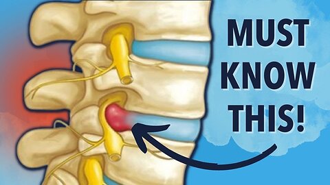 Why Herniated Disc Exercises Don't Work. Must Know This!