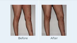 American Vein & Vascular // In-Office Varicose Vein Treatment