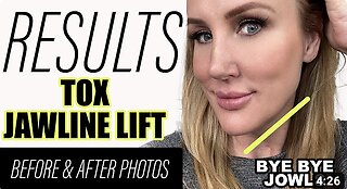 Tox Jawline Lift // RESULTS