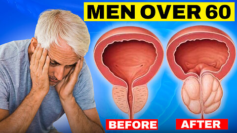 PROSTATE HEALTH in YOUR 60: Management TO CURE Enlarged Prostate