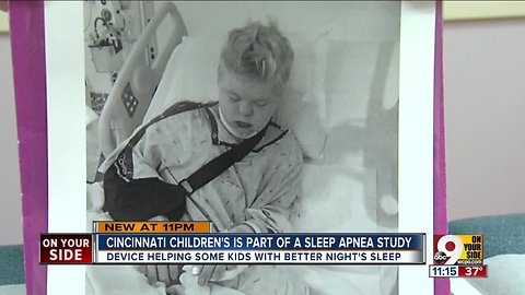 Solving sleep apnea in Down syndrome kids