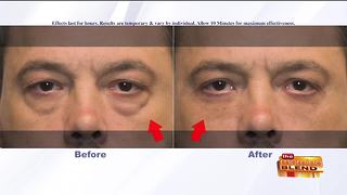 Rapidly Fix Puffy Eyes in Minutes