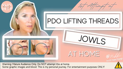 PDO COG Lift Threads for Jowls - BEFORE & AFTER
