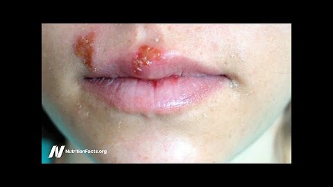 Benefits of Tea Tree Oil For Warts and Cold Sores