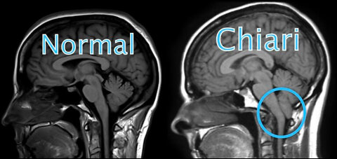 Rabbit Hole Radio - Popeye Has Chiari & CCI