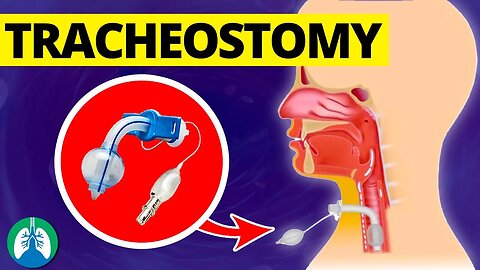 Tracheostomy (Medical Definition) | Quick Explainer Video
