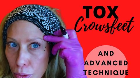 How to Tox Crows feet & Advanced Technique for STUBBORN lines #botulax