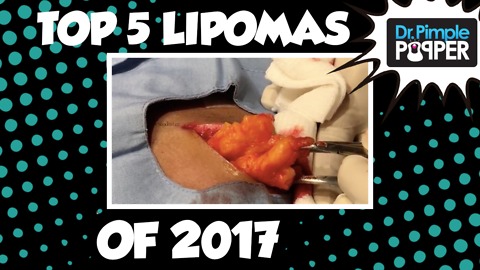 Top 5 Lipomas of 2017