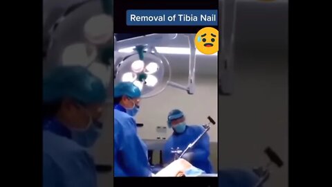 tibia nail removel 😢, gand faad rod removal 😯, fabula nail remove , tibia and fabula