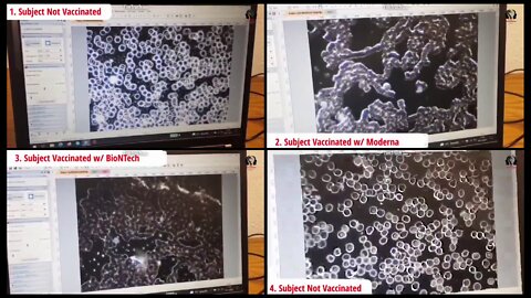 Vaccinated (with Covid 19 Vaccines) vs Unvaccinated Blood under the microscope..