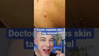 Doctor explains interesting skin tag removal!