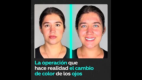 Queratopigmentación: la operación de cambio de color de los ojos