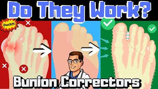 Do Bunion Correctors Work? [How To SHRINK Bunions Naturally!]