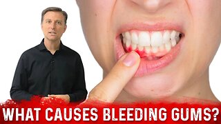 What Causes Bleeding Gums and How to Cure It – Stop Bleeding Gums – Dr.Berg