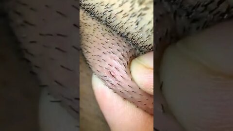 Ingrown Hair Removal - Must Hurt..