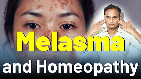 Melasma and Homeopathy Treatment .