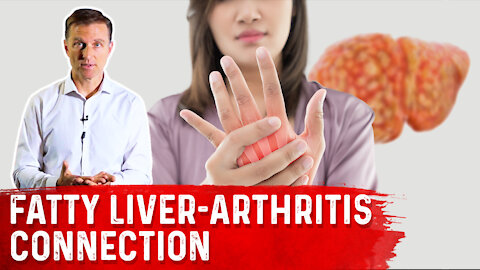 Why Does a Fatty Liver Triggers Arthritis?